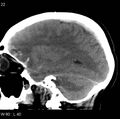 Cerebral hemorrhagic contusion with subdural and subarachnoid hemorrhage (Radiopaedia 10680-11146 C 15).jpg