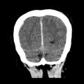 Cerebral hemorrhagic contusions (Radiopaedia 23145-23188 Coronal non-contrast 36).jpg