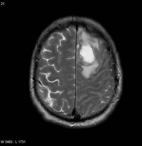 File:Cerebral metastases - renal cell carcinoma (Radiopaedia 5510-7246 Axial T2 6).jpg