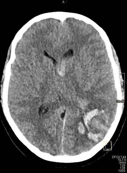 File:Cerebral venous sinus thrombosis (Radiopaedia 91329-108965 Axial non-contrast 27).jpg