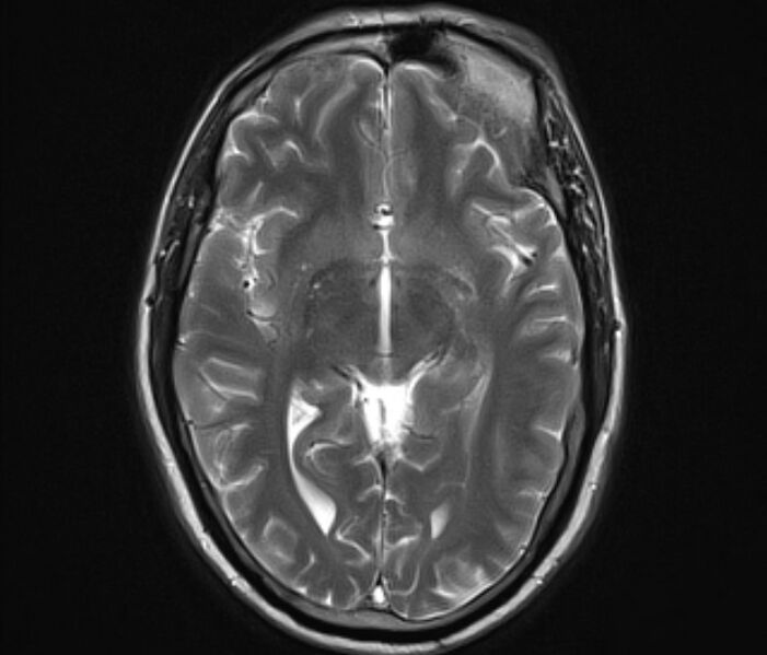 File:Cerebral venous thrombosis (Radiopaedia 71207-81504 Axial T2 13).jpg