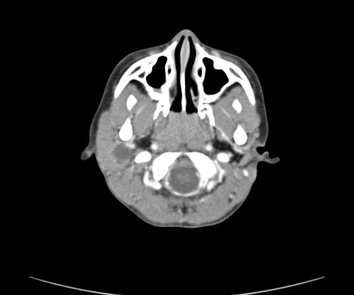 File:Cervical cystic lymphangioma (Radiopaedia 63655-72332 Axial + contrast 4).jpg