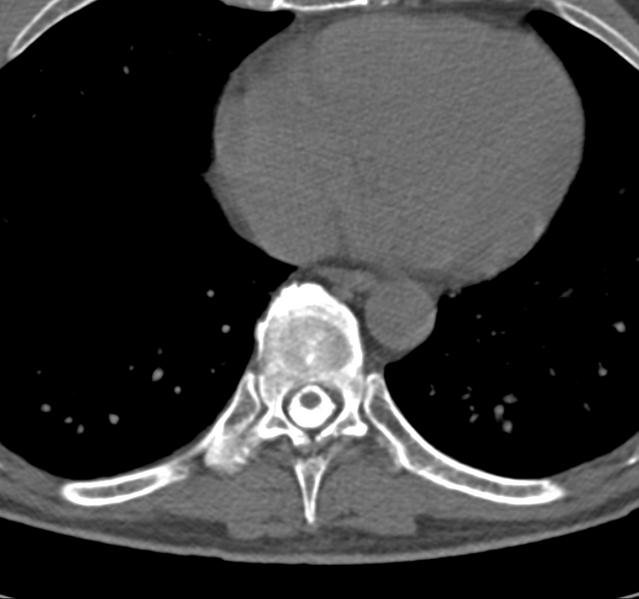 File:Cervical dural CSF leak on MRI and CT treated by blood patch (Radiopaedia 49748-54996 B 68).png