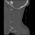 Cervical flexion teardrop fracture with cord hemorrhage (Radiopaedia 32497-33454 Sagittal bone window 38).jpg