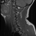 Cervical flexion teardrop fracture with cord hemorrhage (Radiopaedia 32497-33455 Sagittal T1 15).jpg
