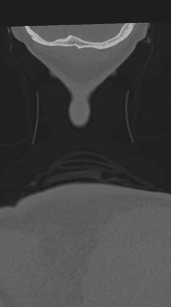 File:Cervical intercalary bone (Radiopaedia 35211-36748 Coronal bone window 87).png