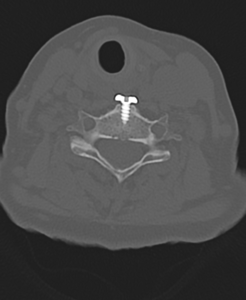 File:Cervical spine ACDF loosening (Radiopaedia 48998-54071 Axial bone window 39).png