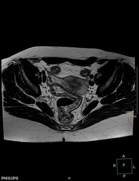 File:Cesarian scar endometriosis (Radiopaedia 68495-78066 Axial T2 11).jpg