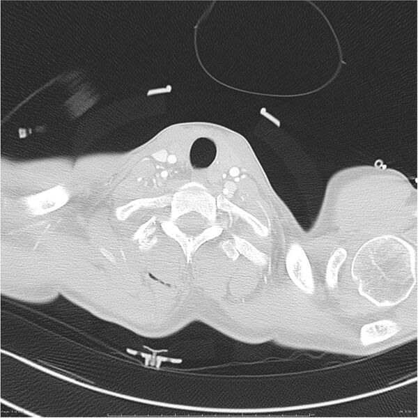 File:Chest and abdomen multi-trauma (Radiopaedia 26294-26425 lung window 9).jpg