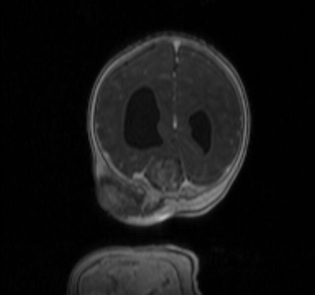 File:Chiari III malformation with occipital encephalocele (Radiopaedia 79446-92559 Coronal T1 C+ mpr 38).jpg