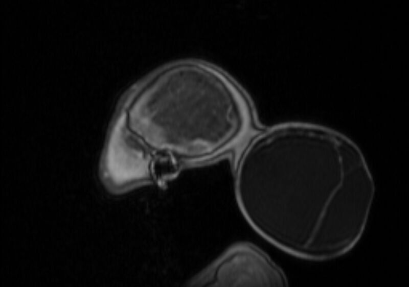 File:Chiari III malformation with occipital encephalocele (Radiopaedia 79446-92559 Sagittal T1 C+ mpr 14).jpg