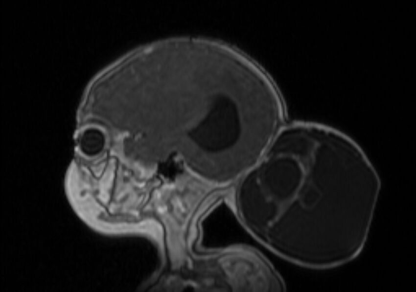Chiari III malformation with occipital encephalocele (Radiopaedia 79446-92559 Sagittal T1 C+ mpr 23).jpg