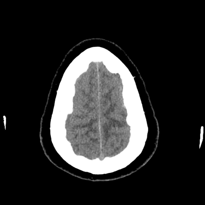 Chiasmatic-hypothalamic juvenile pilocytic astrocytoma (Radiopaedia 78533-91237 Axial non-contrast 50).jpg