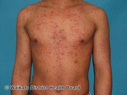 Widespread distribution in chicken pox with sparing of palms of hands