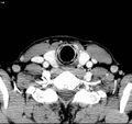 Chondrosarcoma - larynx (Radiopaedia 4588-6698 A 9).jpg