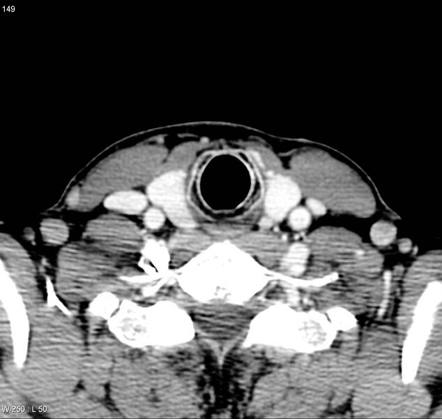 File:Chondrosarcoma - larynx (Radiopaedia 4588-6698 A 9).jpg