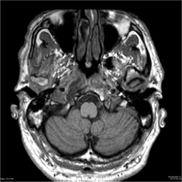 File:Chondrosarcoma of skull base- grade II (Radiopaedia 40948-43654 Axial T1 14).jpg