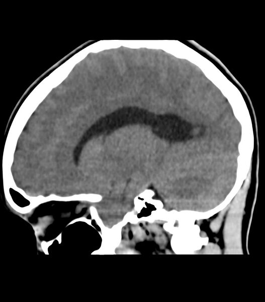 File:Choroid plexus carcinoma (Radiopaedia 91013-108552 B 28).jpg