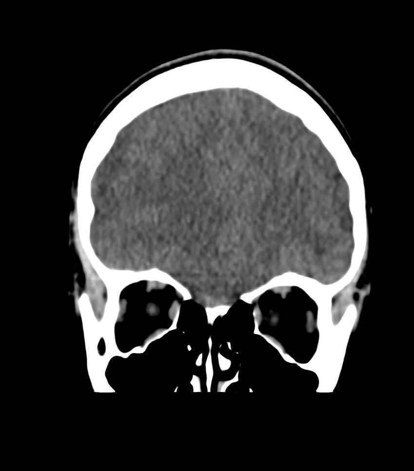 Choroid plexus carcinoma (Radiopaedia 91013-108552 Coronal non-contrast 21).jpg