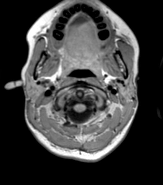 File:Choroid plexus carcinoma (Radiopaedia 91013-108553 Axial T1 21).jpg