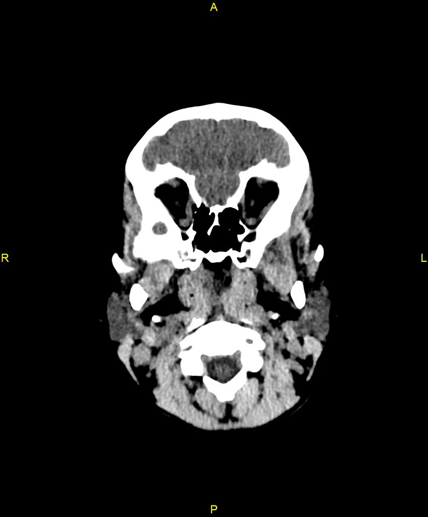 Choroidal fissure cyst (Radiopaedia 89481-106465 Axial non-contrast 17).jpg
