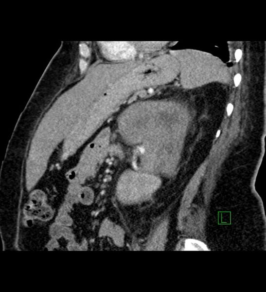 File:Chromophobe renal cell carcinoma (Radiopaedia 84239-99519 D 44).jpg