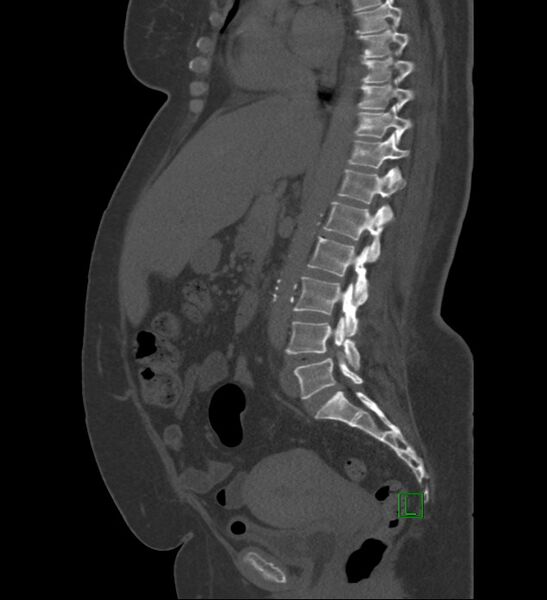 File:Chromophobe renal cell carcinoma (Radiopaedia 84239-99519 Sagittal bone window 55).jpg