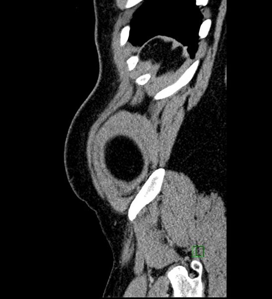 File:Chromophobe renal cell carcinoma (Radiopaedia 84286-99573 I 5).jpg