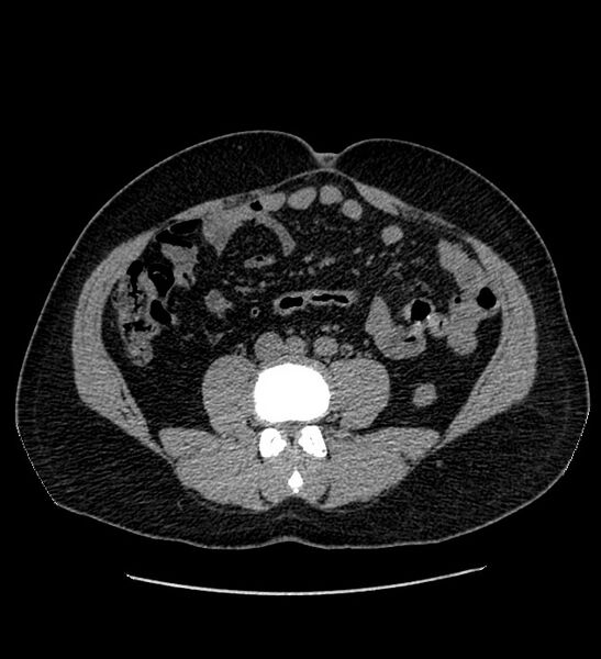 File:Chromophobe renal cell carcinoma (Radiopaedia 84337-99693 Axial non-contrast 88).jpg
