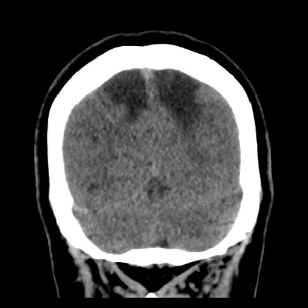 File:Chronic bilateral occipital lobe infarcts (Radiopaedia 31276-31996 Coronal non-contrast 38).jpg