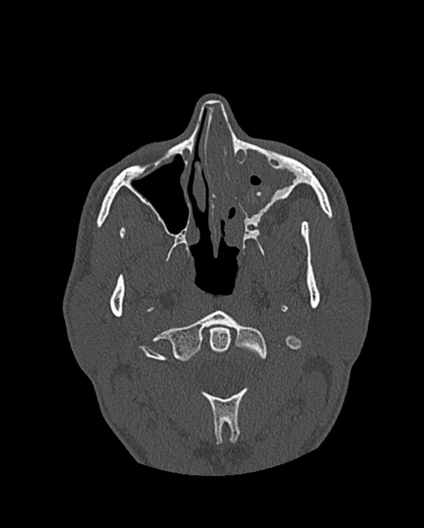 Chronic maxillary sinusitis caused by a foreign body (Radiopaedia 58521-65676 Axial bone window 128).jpg