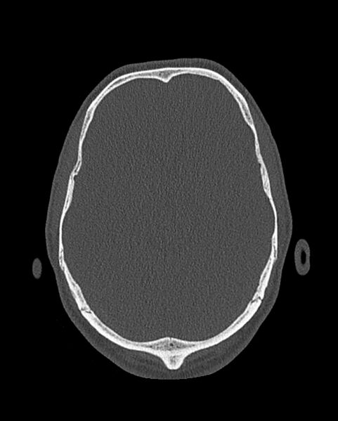 File:Chronic maxillary sinusitis caused by a foreign body (Radiopaedia 58521-65676 Axial bone window 338).jpg