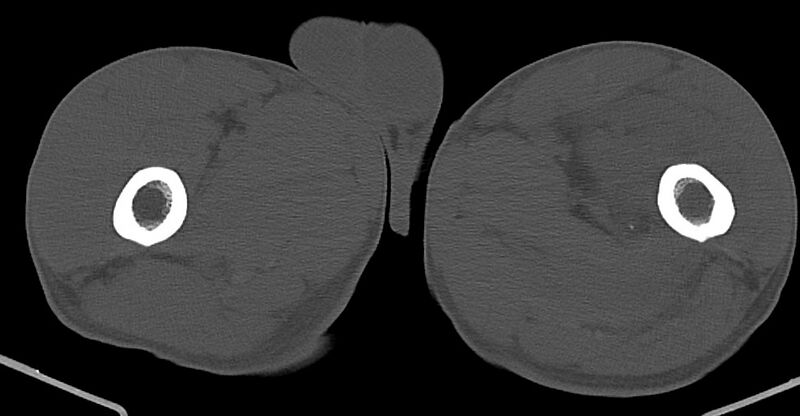 File:Chronic osteomyelitis (with sequestrum) (Radiopaedia 74813-85822 Axial non-contrast 70).jpg