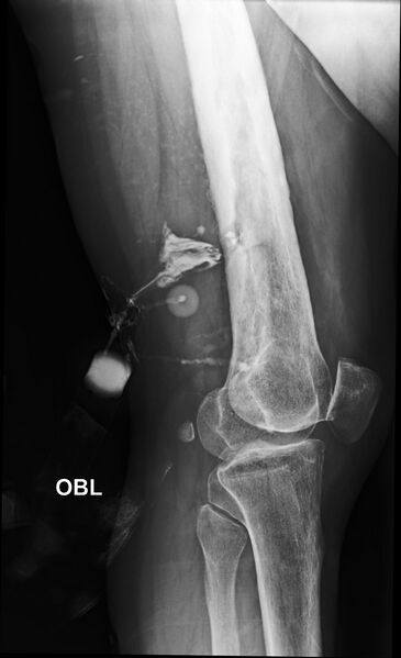 File:Chronic osteomyelitis of the right femur (Radiopaedia 78913-91802 D 1).jpg