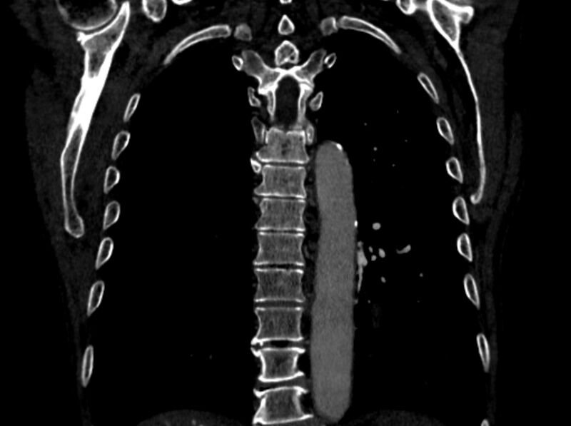 File:Chronic pulmonary embolism (Radiopaedia 91241-108843 A 83).jpg