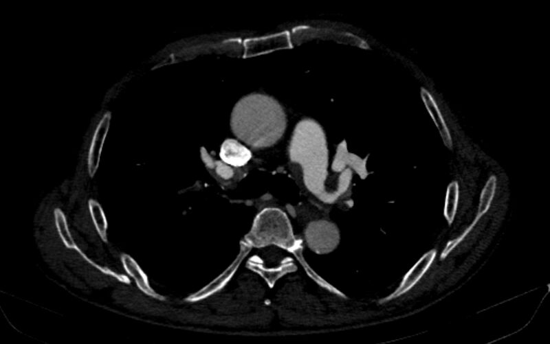 File:Chronic pulmonary embolism (Radiopaedia 91241-108843 B 77).jpg