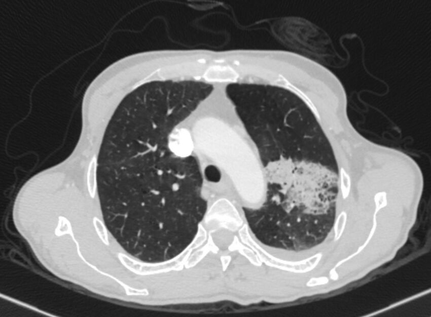 Chronic pulmonary embolism with bubbly consolidation (Radiopaedia 91248-108850 Axial lung window 41).jpg