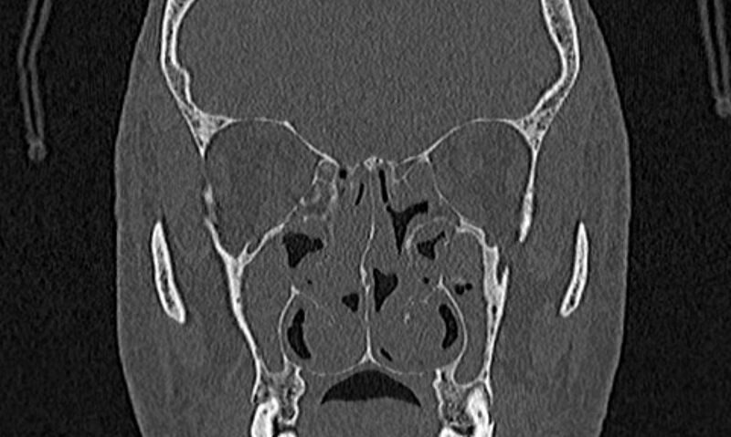 File:Chronic rhinosinusitis (Radiopaedia 65079-74075 Coronal bone window 42).jpg
