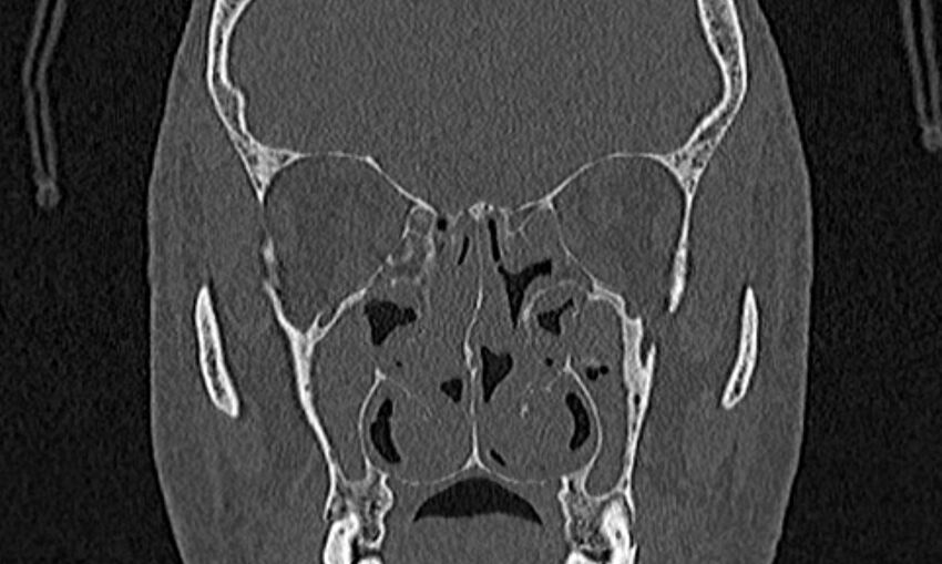Chronic rhinosinusitis (Radiopaedia 65079-74075 Coronal bone window 42).jpg