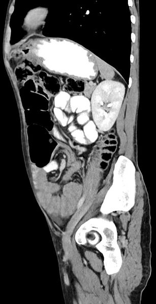 File:Chronic small bowel volvulus (Radiopaedia 75224-86322 C 48).jpg