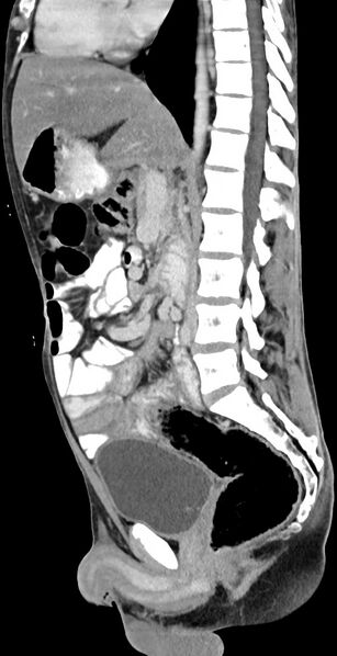 File:Chronic small bowel volvulus (Radiopaedia 75224-86322 C 77).jpg