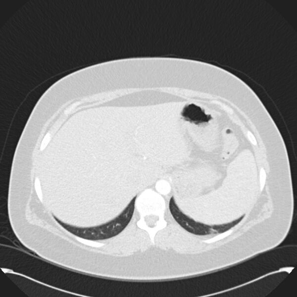 File:Chronic thromboembolic pulmonary hypertension (CTEPH) (Radiopaedia 74597-85531 Axial lung window 50).jpg