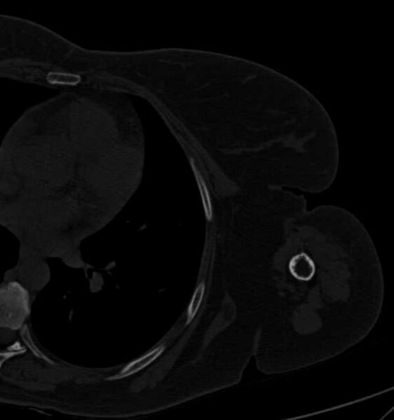 File:Clear cell chondrosarcoma - humerus (Radiopaedia 63104-71612 Axial bone window 94).jpg