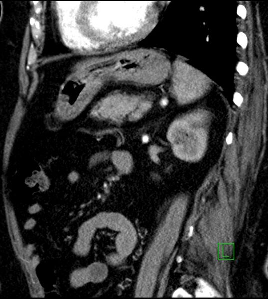 File:Clear cell renal cell carcinoma (Radiopaedia 85004-100537 D 23).jpg