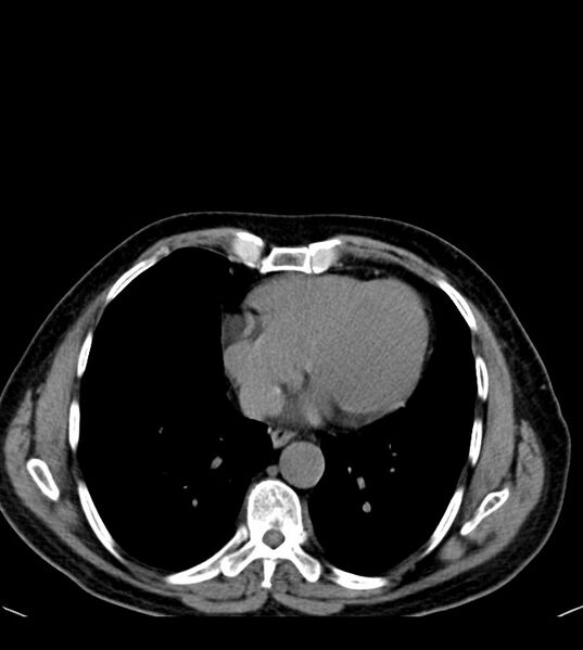 File:Clear cell renal cell carcinoma (Radiopaedia 85006-100539 Axial non-contrast 8).jpg