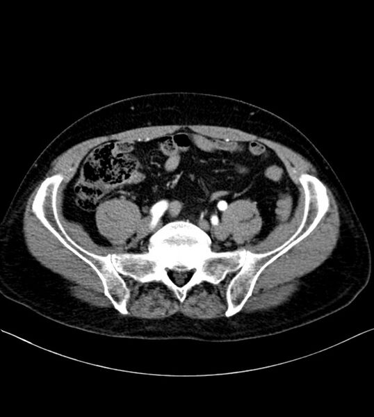 File:Clear cell renal cell carcinoma (Radiopaedia 85006-100539 B 65).jpg