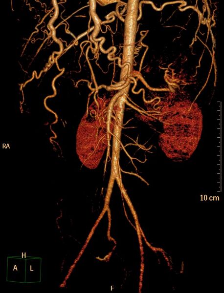 File:Coarctation of the aorta (Radiopaedia 27458-27657 3D 14).jpg