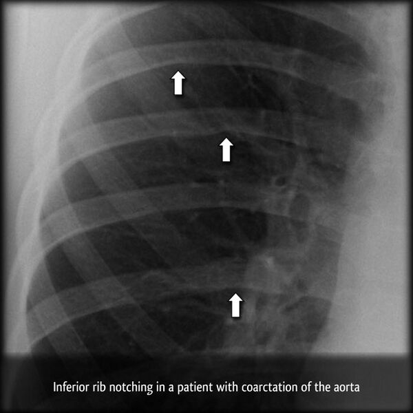 File:Coarctation of the aorta (Radiopaedia 6279-66644 A 1).jpg