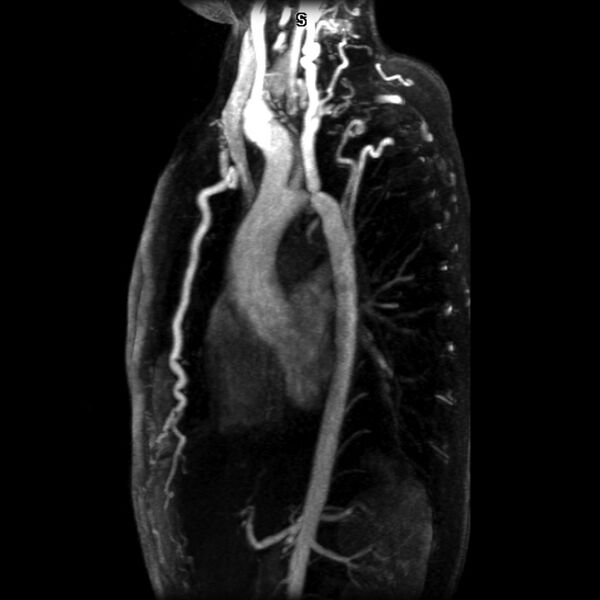 File:Coarctation of the aorta (Radiopaedia 6289-7691 MRA 1).jpg