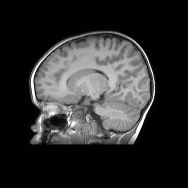 File:Cochlear nerve aplasia - unilateral (Radiopaedia 87910-104413 Sagittal T1 29).jpg